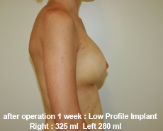 plastic-surgery-breast-augmentation